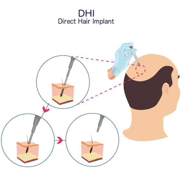 DHI Hair Transplant - Direct Hair Implantation - Harley Street HTC