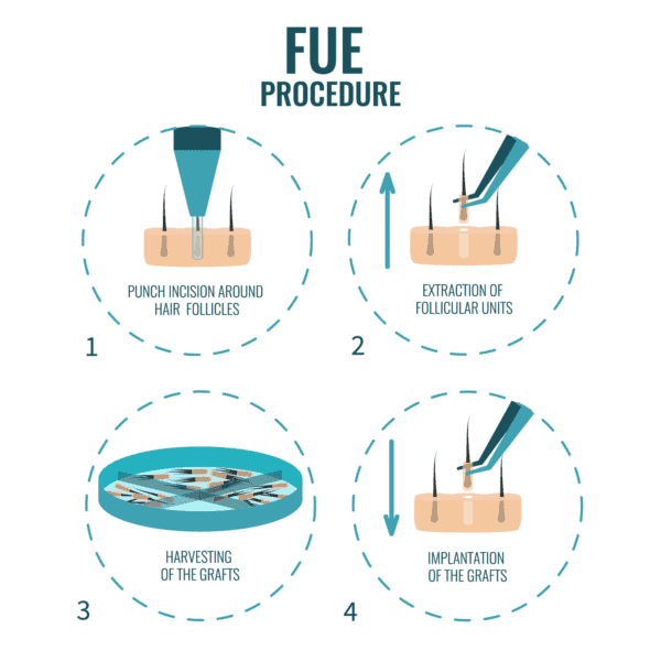 FUE Hair Transplant Procedure