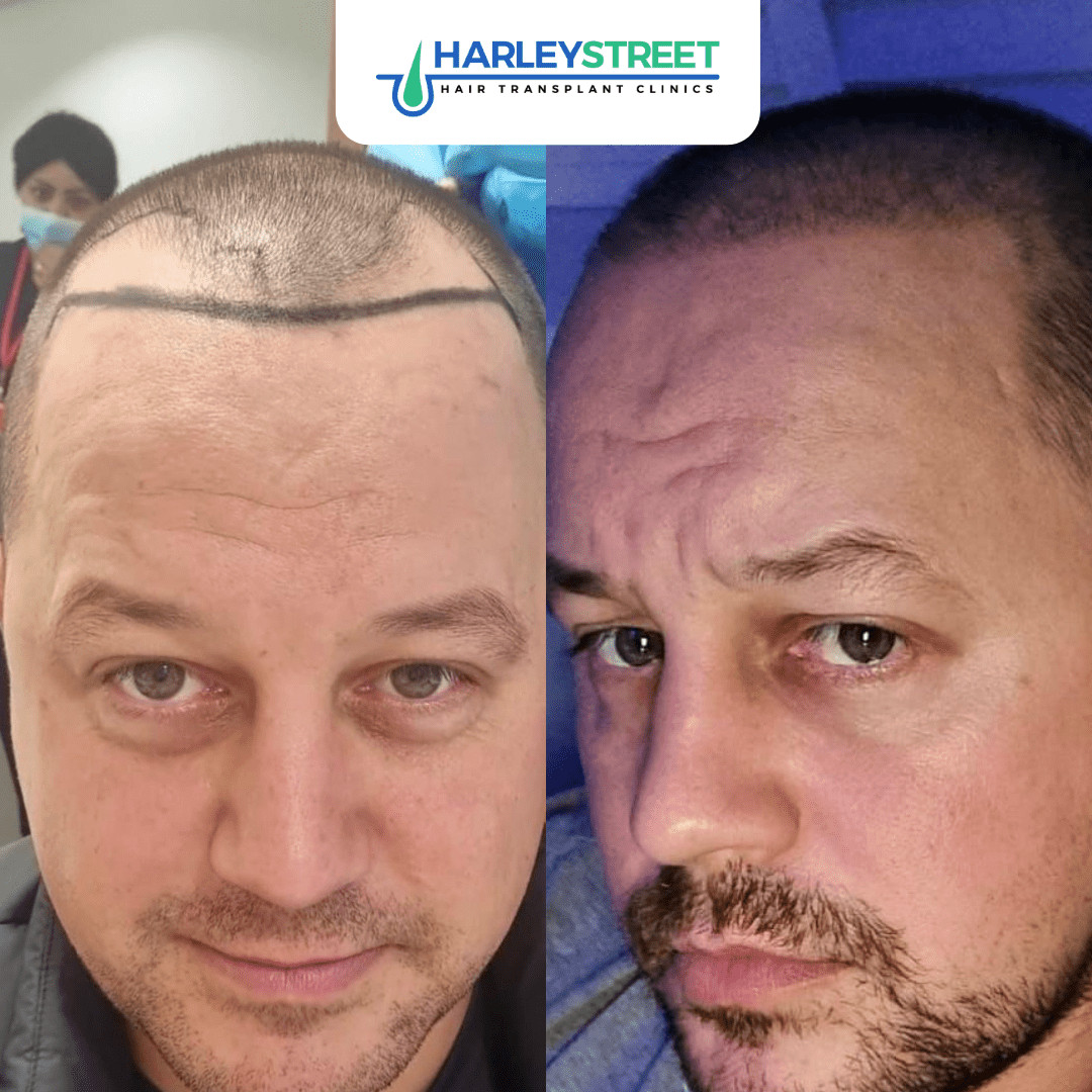 harley street hair transplant patient fue procedure