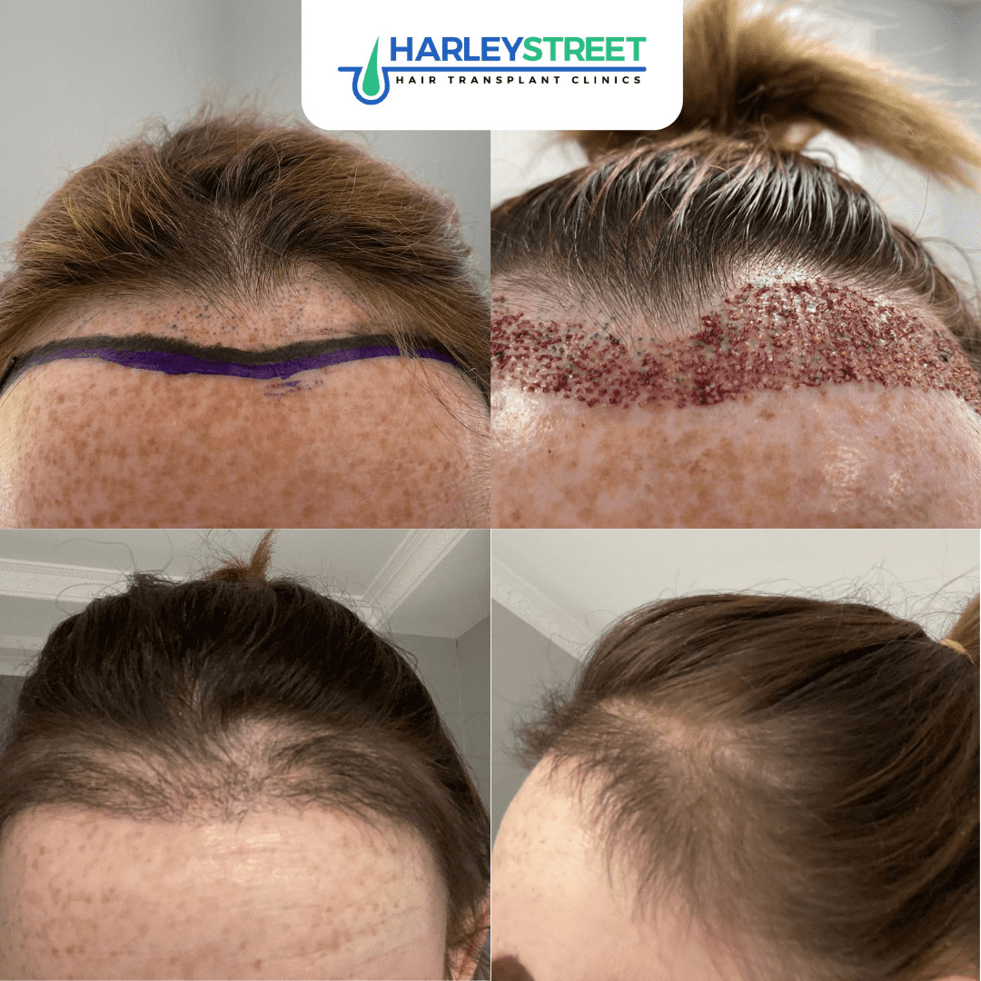 harley street hair transplant fue procedure for female hair loss