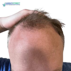 Hair Transplant Before and After Results Alan Garrett Pre surgery