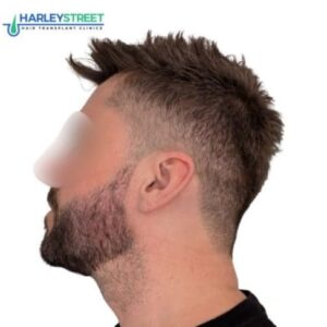 Beard transplant after paul 1