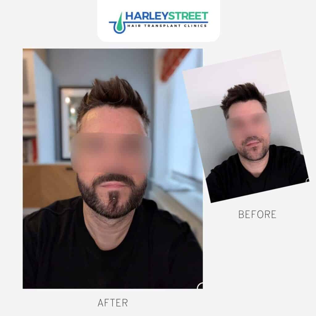 Harley Street Hair Transplant Clinics London Home Page Beard transplant before and after Paul