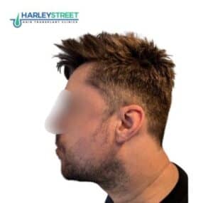 Beard transplant before paul 1