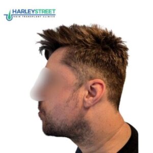 Beard transplant before paul 1