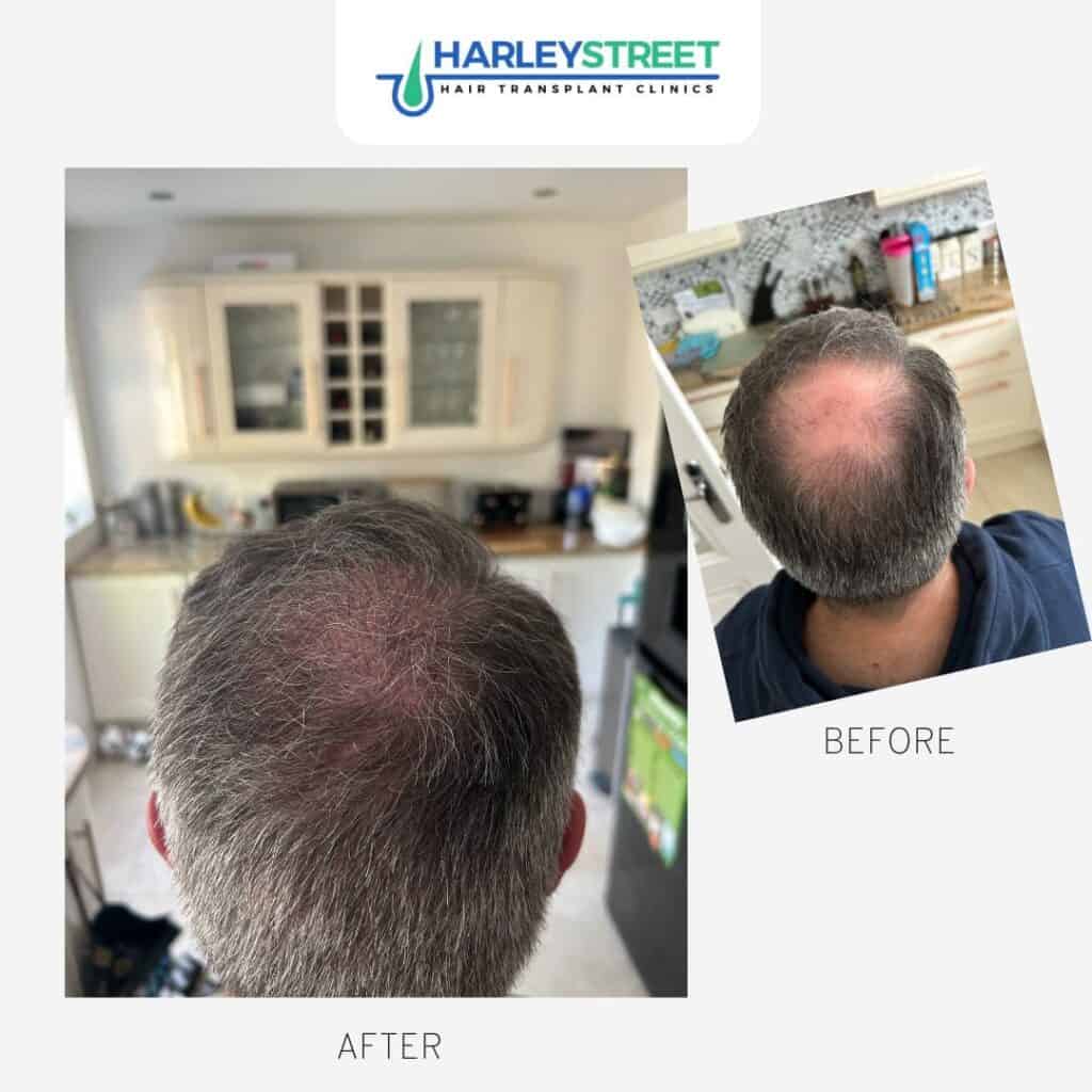 Harley Street Hair Transplant Clinics London Home Page Before and after crown ht chris h