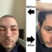 Before and after hair transplant swelling