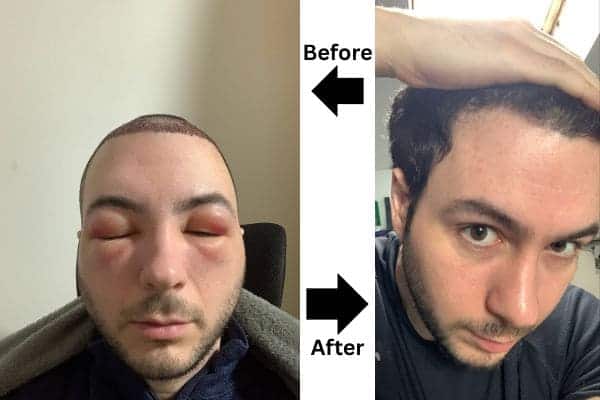 Before and after hair transplant swelling