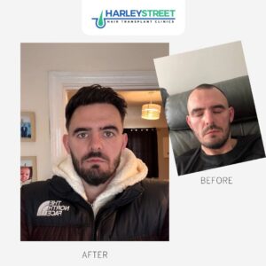 Before and after ht ryan g