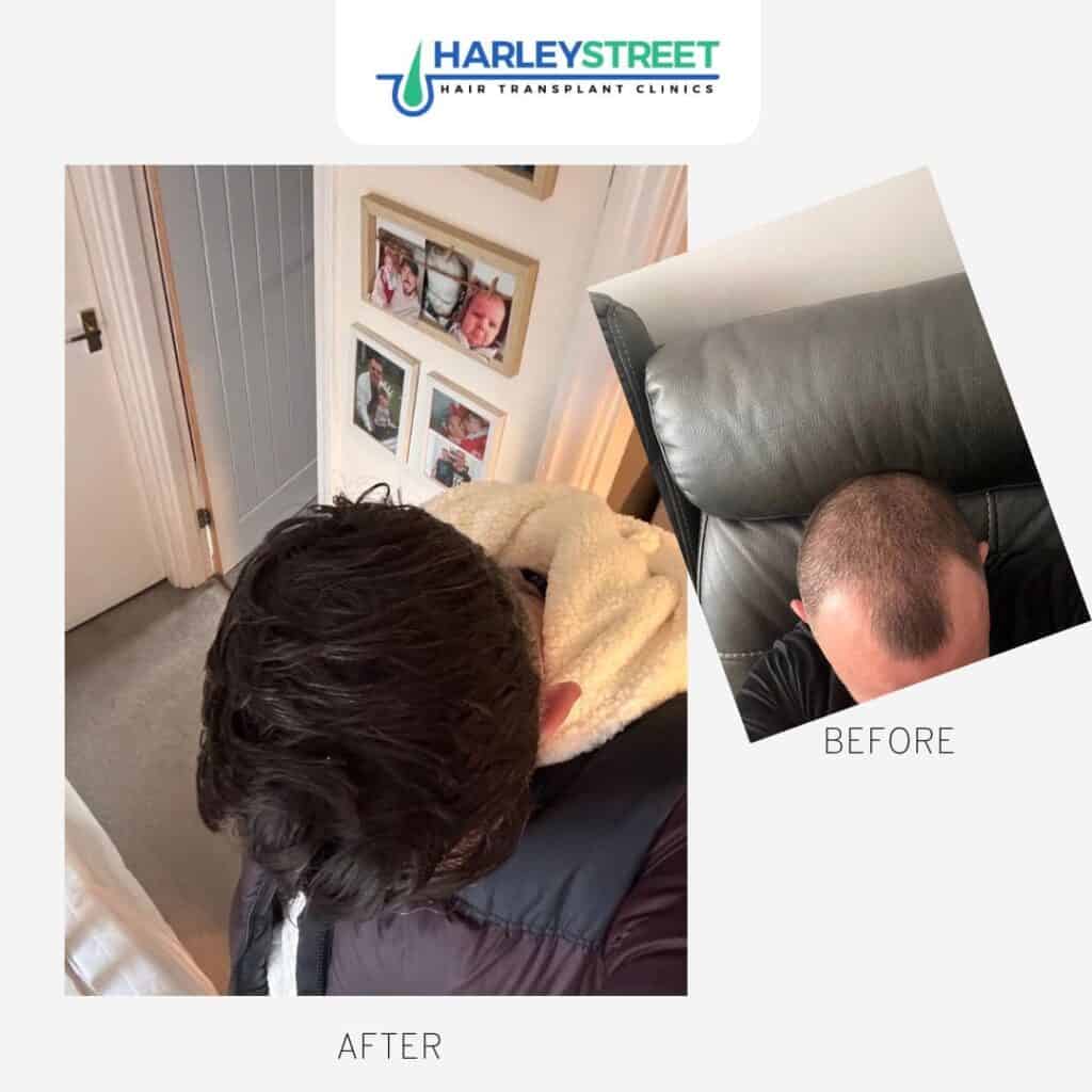 Harley Street Hair Transplant Clinics London Home Page Before and after ht top view ryan g