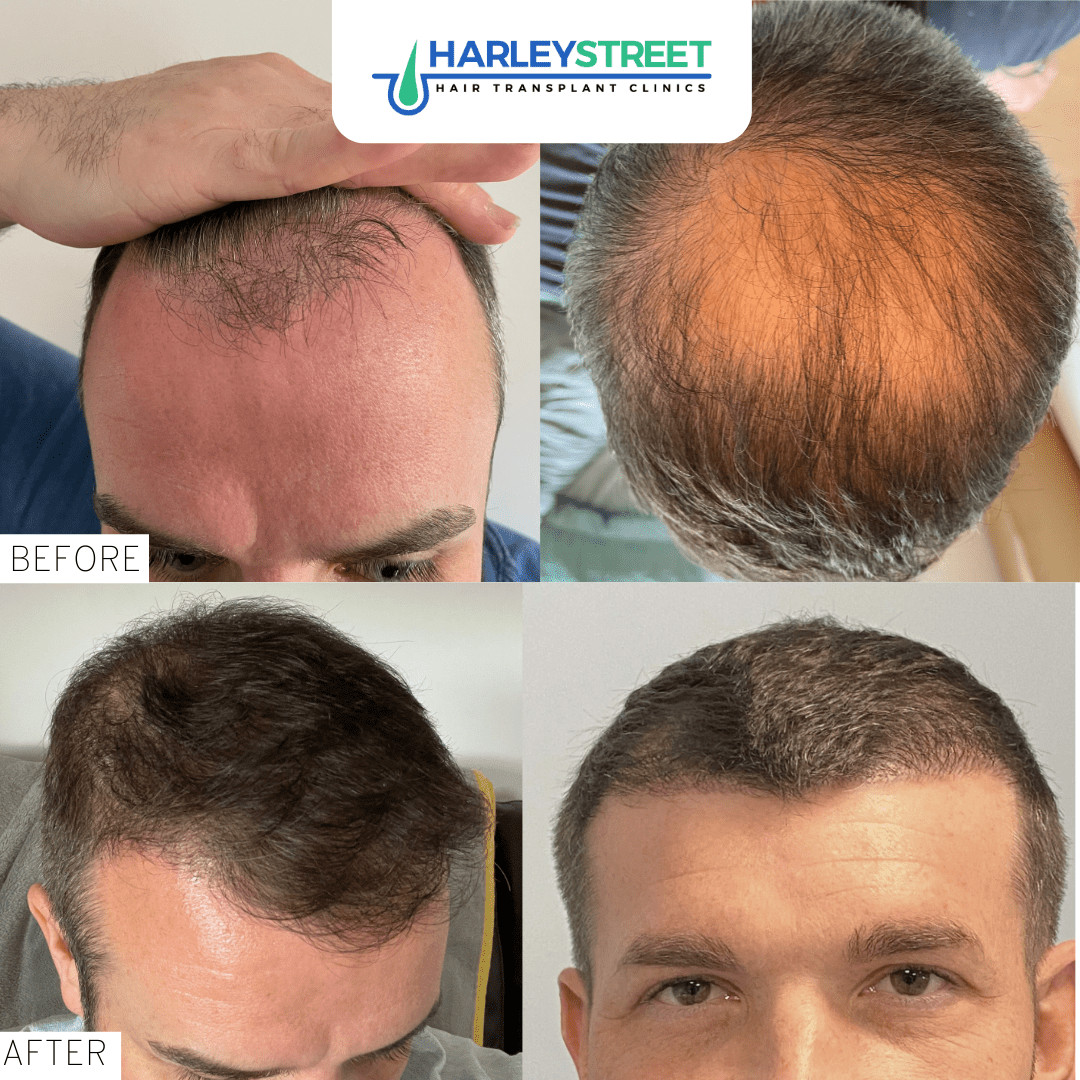Hair Transplant Newcastle - Harley Street HT Clinics