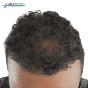 Hair Transplant Before and After Results Calvin 9 months later