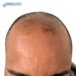 Hair Transplant Before and After Results Calvin Pre surgery