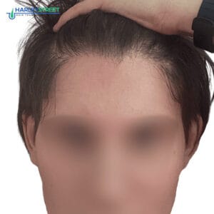 Hair Transplant Before and After Results Charlotte Lloyd 6 months