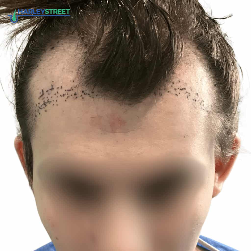 Charlotte Lloyd pre surgery