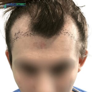 Hair Transplant Before and After Results Charlotte Lloyd pre surgery