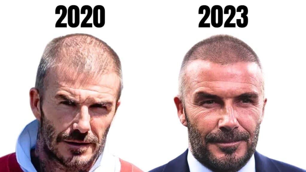 David Beckham before and after hair thinning