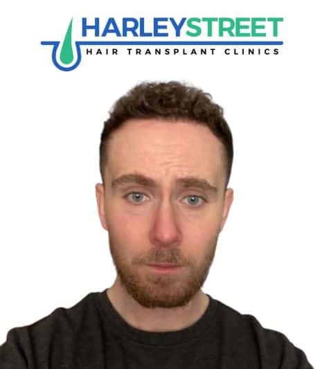 Hair Transplant Before and After Results Declan McD after 1