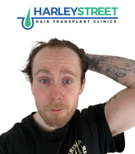 Hair Transplant Before and After Results Declan McD before 1