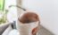 Does hair transplant surgery hurt