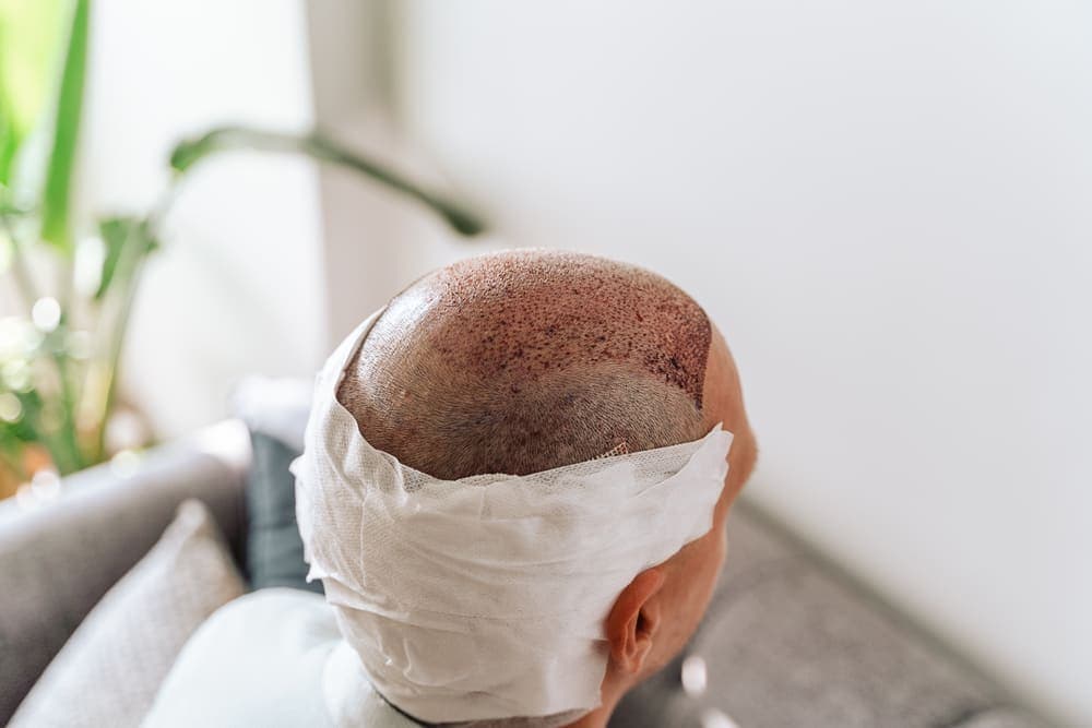 Does hair transplant surgery hurt