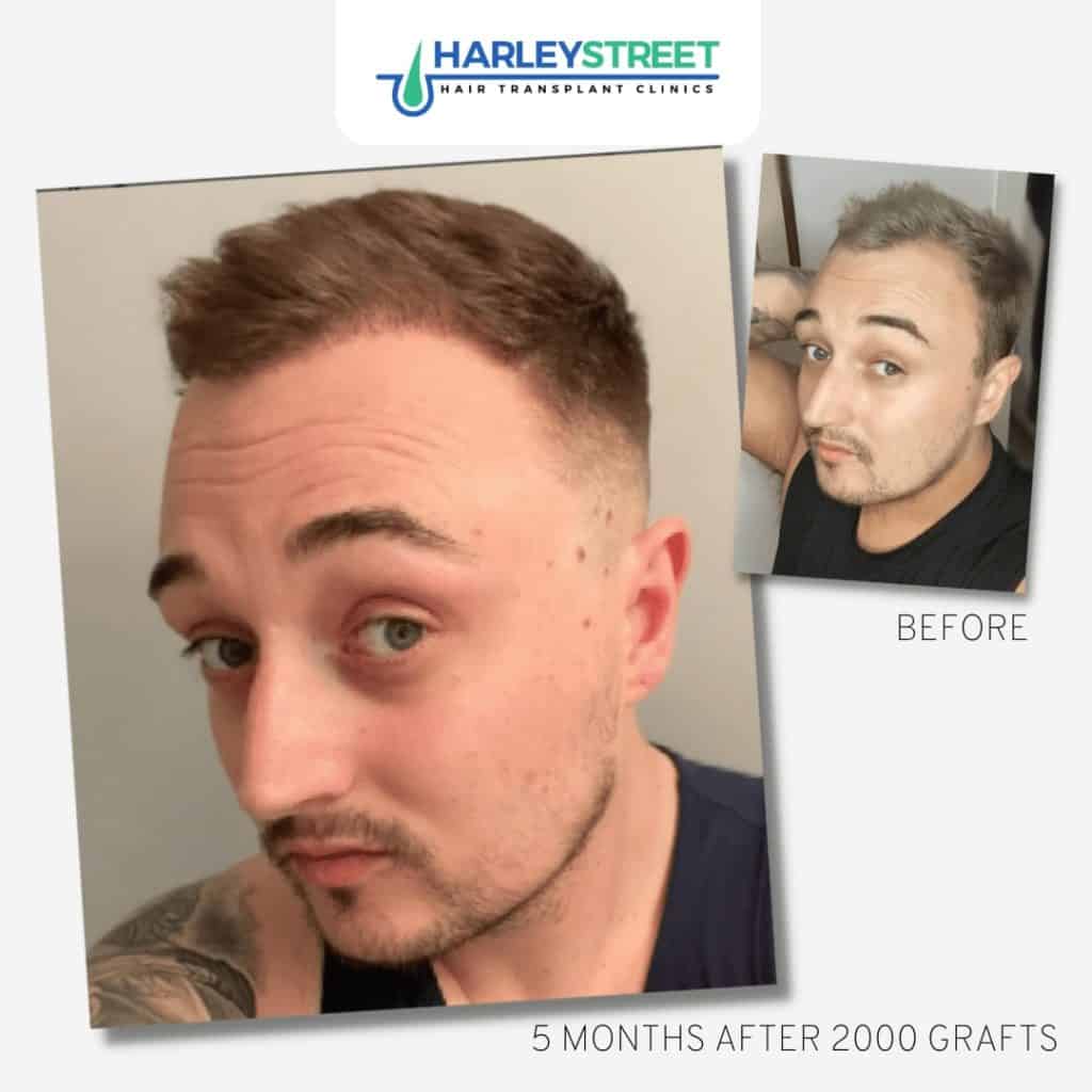 Hair Transplant Aftercare FUE-Before-and-After-2