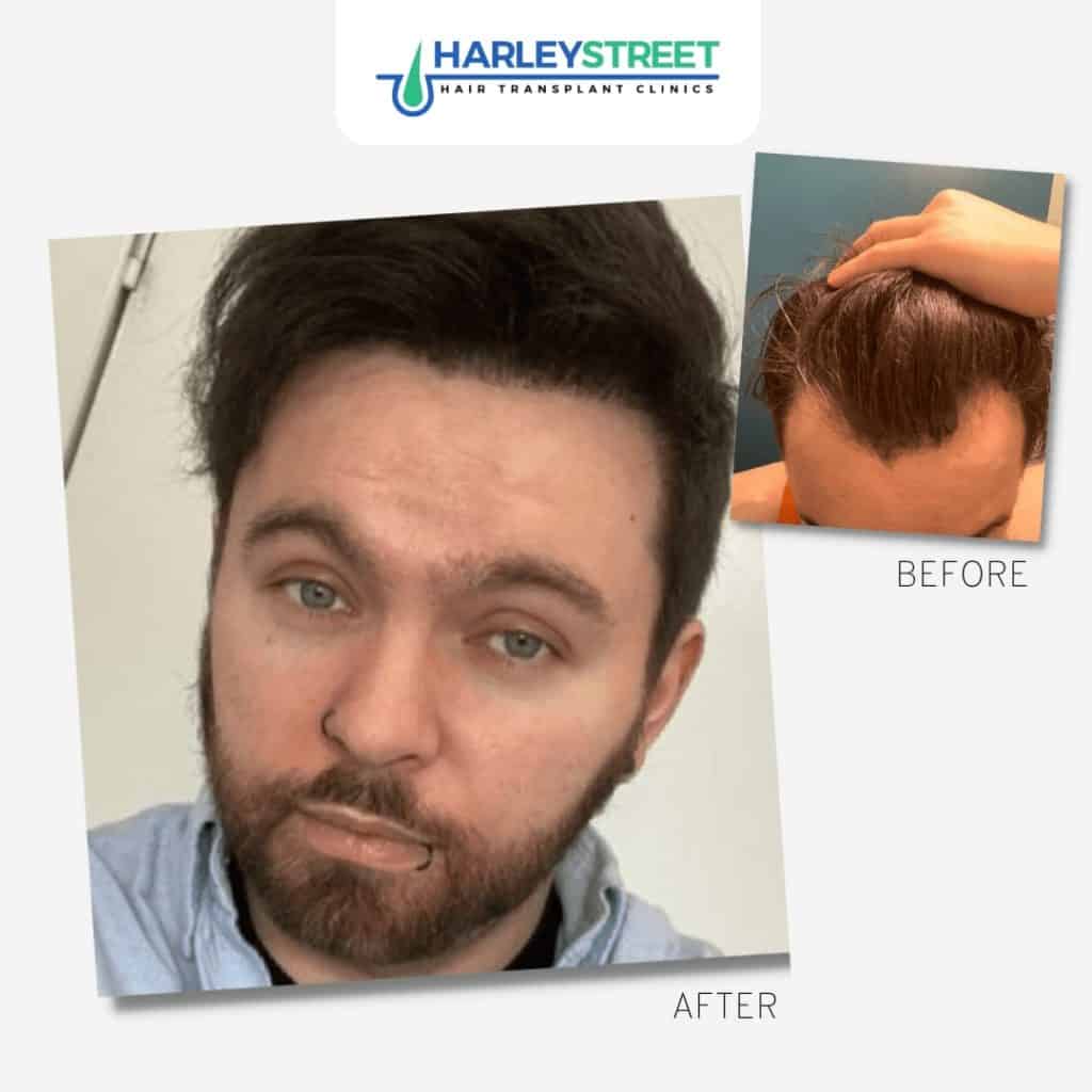 Hair Transplant Aftercare FUE-Before-and-After-3
