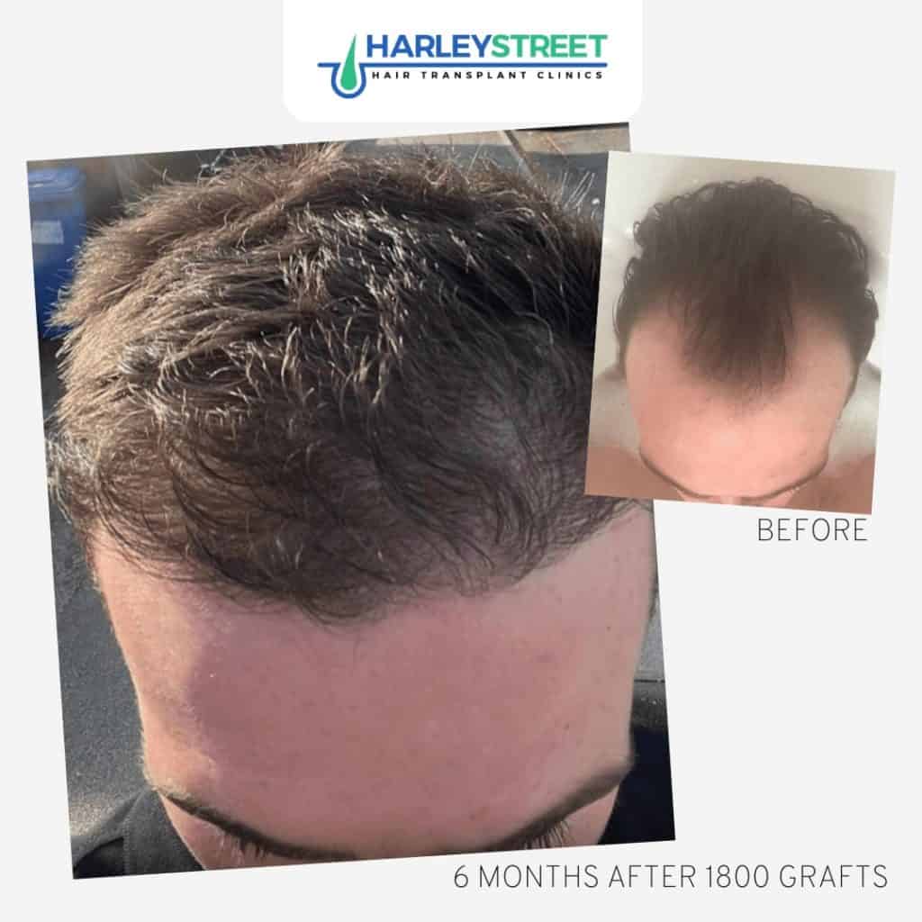 Before and After Results FUE-Before-and-After-4