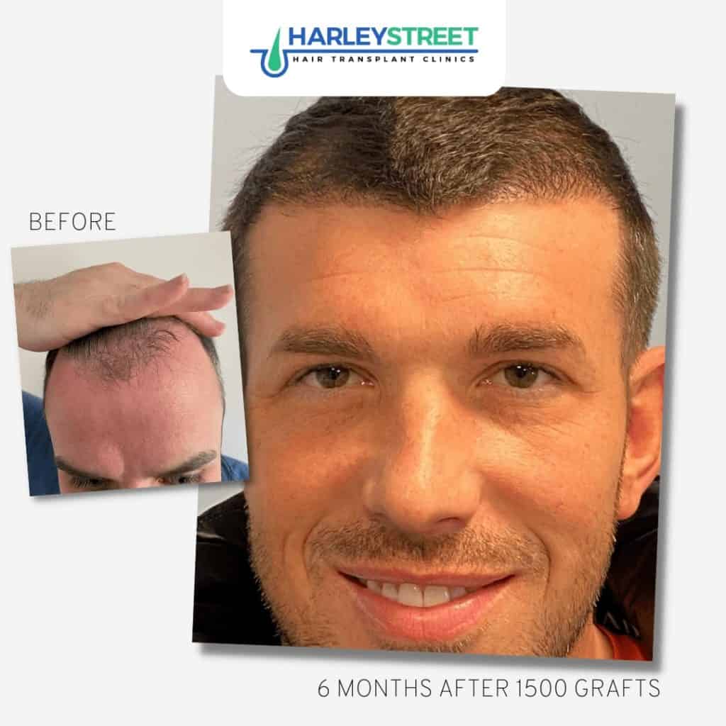 Hair Transplants in Cardiff - HeadQuarters UKHQ Hair Transplants