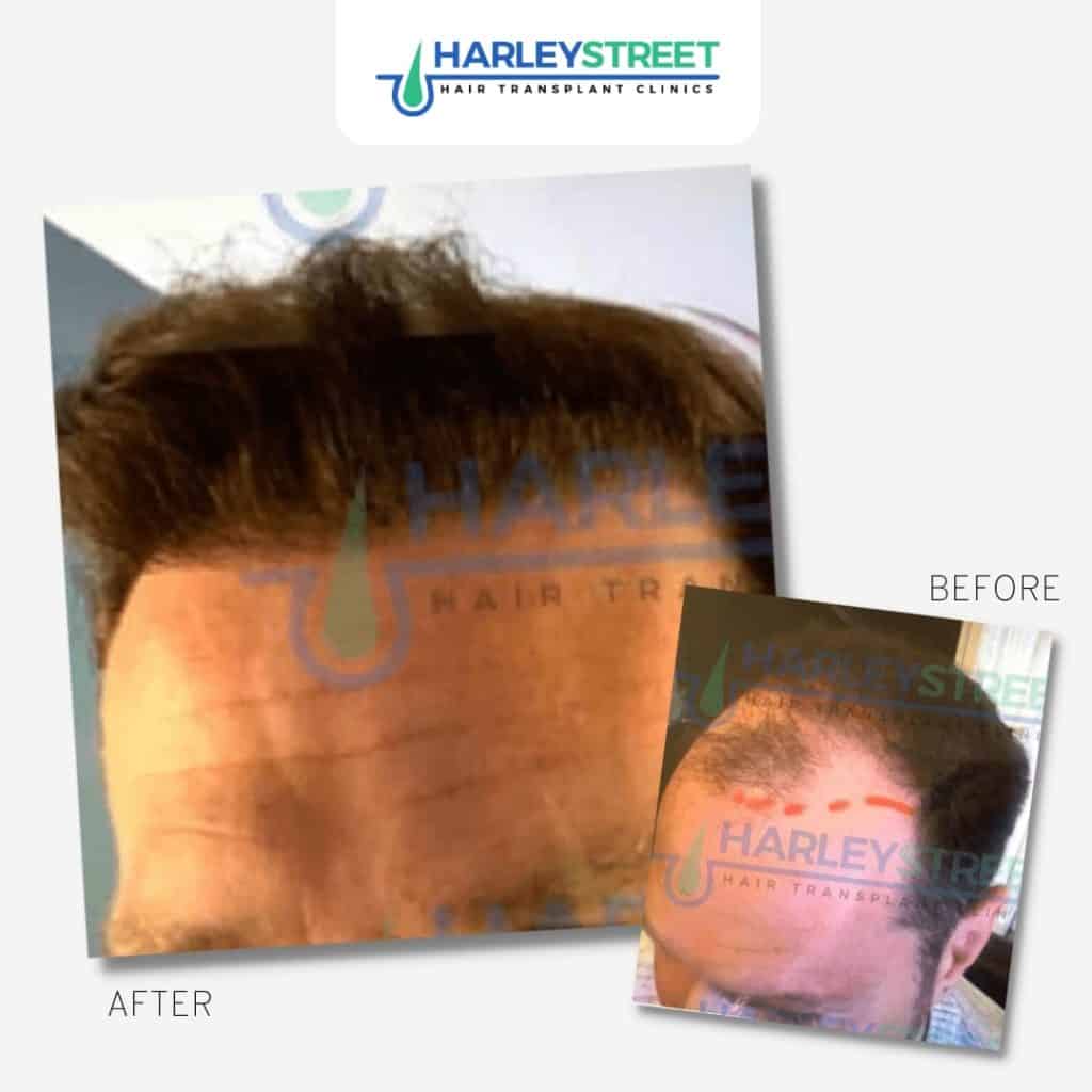 Hair Transplant Aftercare FUE-Before-and-After-7