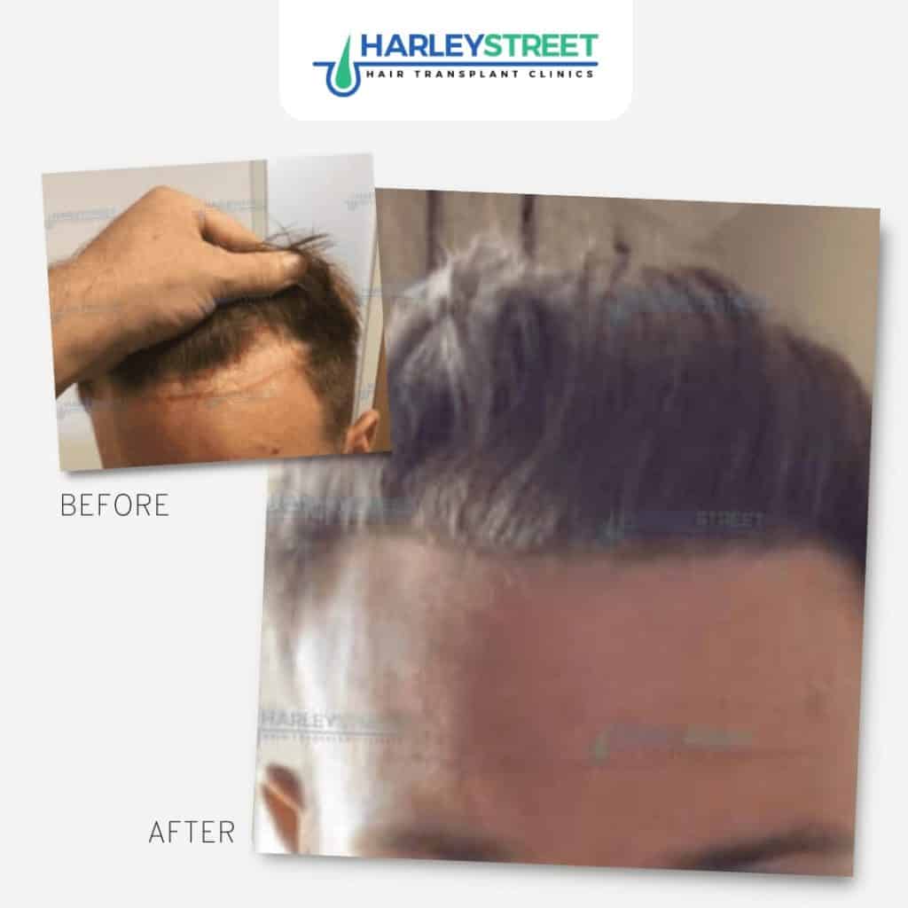 Hair Transplant for a Receding Hairline - Harley Street HTC