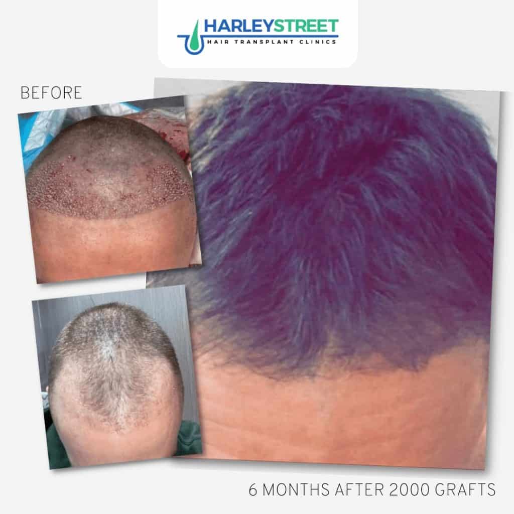 Hair Transplants in Cardiff - HeadQuarters UKHQ Hair Transplants