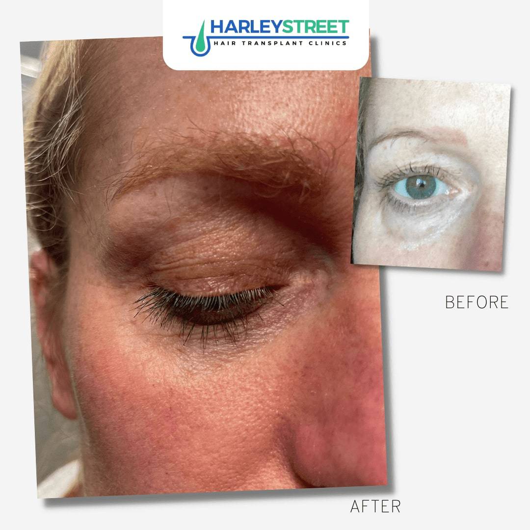 Eyebrow Transplant Birmingham FUE-Eyebrow-Transplant-Before-and-After-14