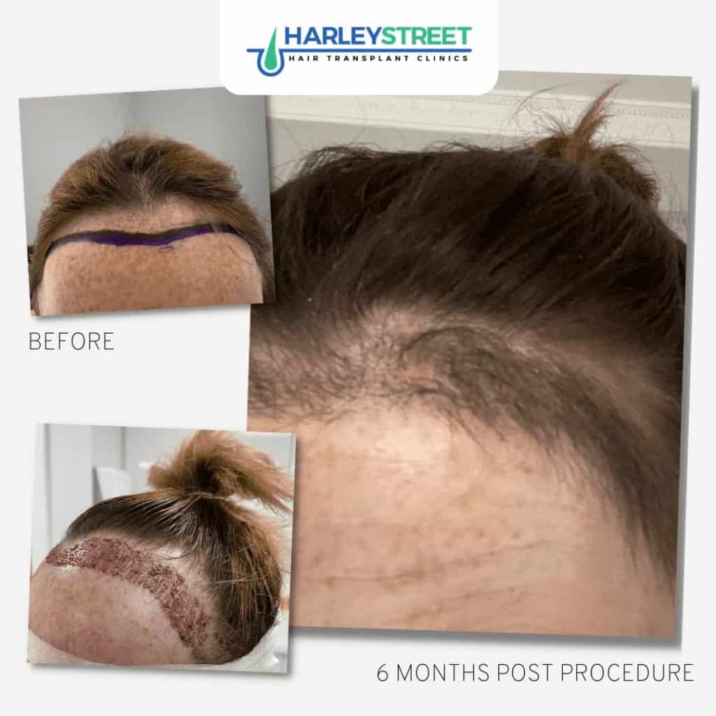 FUE Female Hair Transplant Before and After