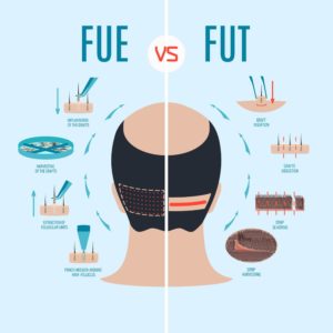 FUE vs FUT in hair transplant methods min