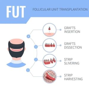 FUT hair extraction method