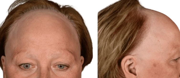 Frontal Fibrosing Alopecia