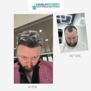 Hair Transplant Cost UK Gerard Before & After