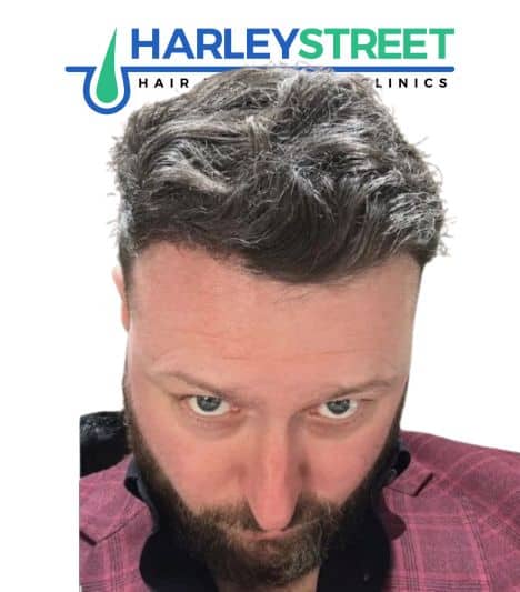 Hair Transplant Before and After Results Gerard H after 1