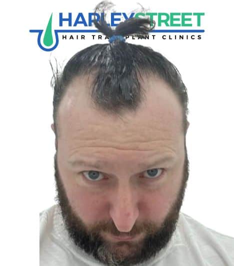 Hair Transplant Before and After Results Gerard H before 1