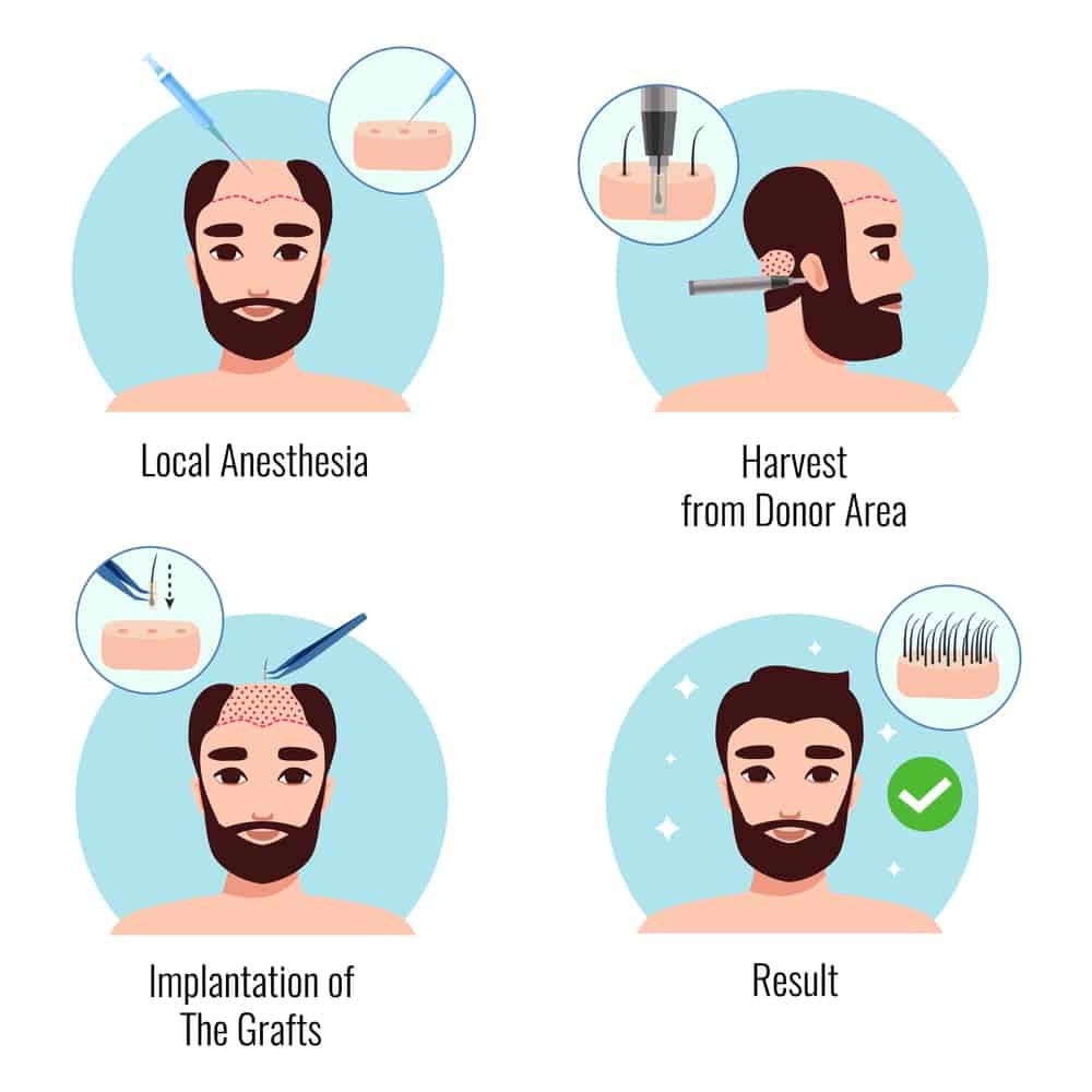 Hair Transplant Procedure and process-min