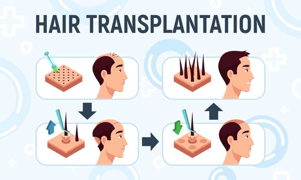 Hair Transplantation statistics