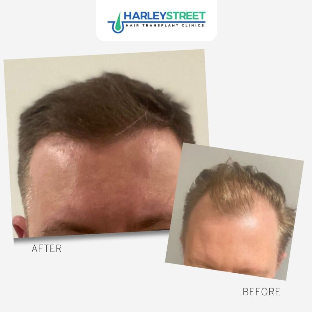 Harley St before and after front hairline and temples