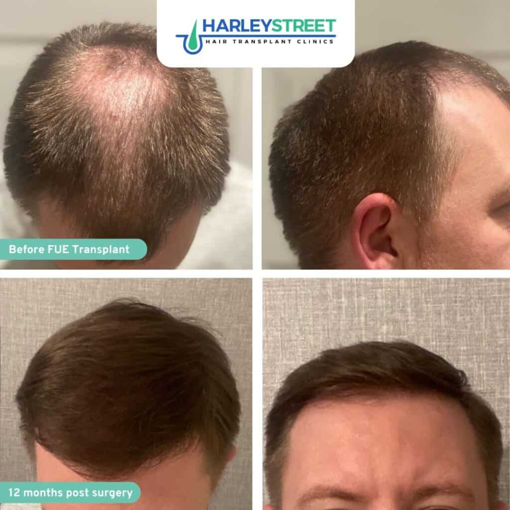 Harley Street HT Clinics crown and hairline before and after