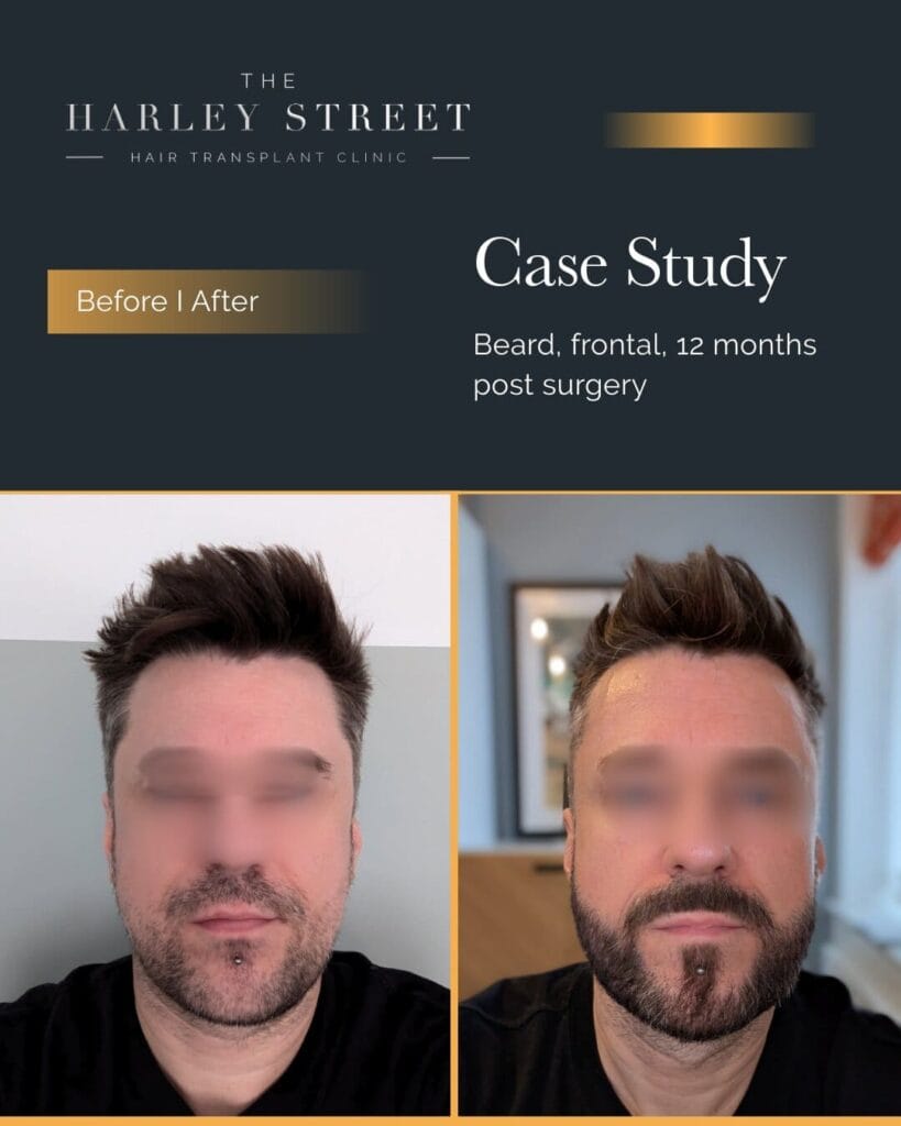 Harley Street HT Patient Beard - P Burley frontal