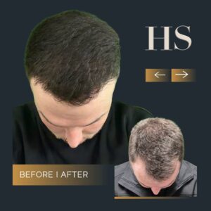 Hairline Hair Transplant Harley Street HT Pt before and after 1