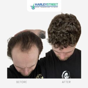 Harley Street HT Pt before and after