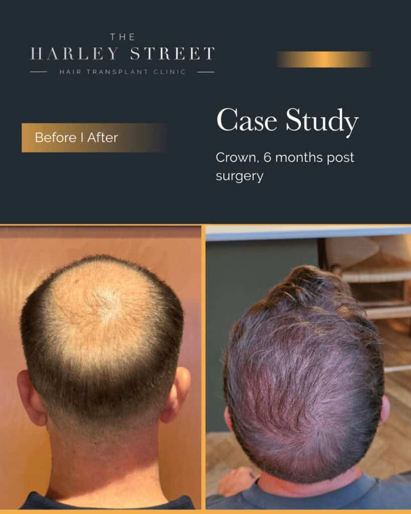Harley Street HT clinics pt, AS crown large