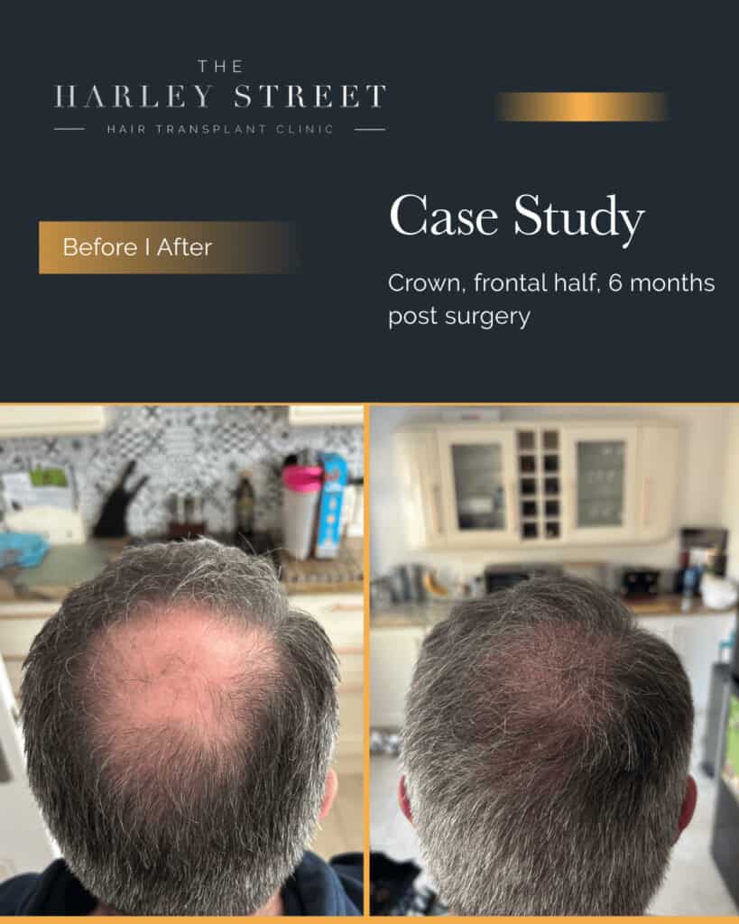 Harley Street HT clinics pt, Chris H2 crown