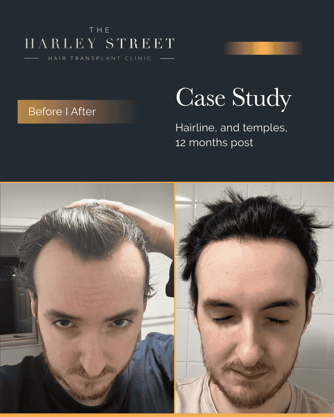 Harley Street HT patient, Elliot hairline